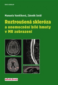 Roztrou&scaron;en&aacute; skler&oacute;za a onemocn&iacute; b&iacute;l&eacute; hmoty v MR zobrazen&iacute;